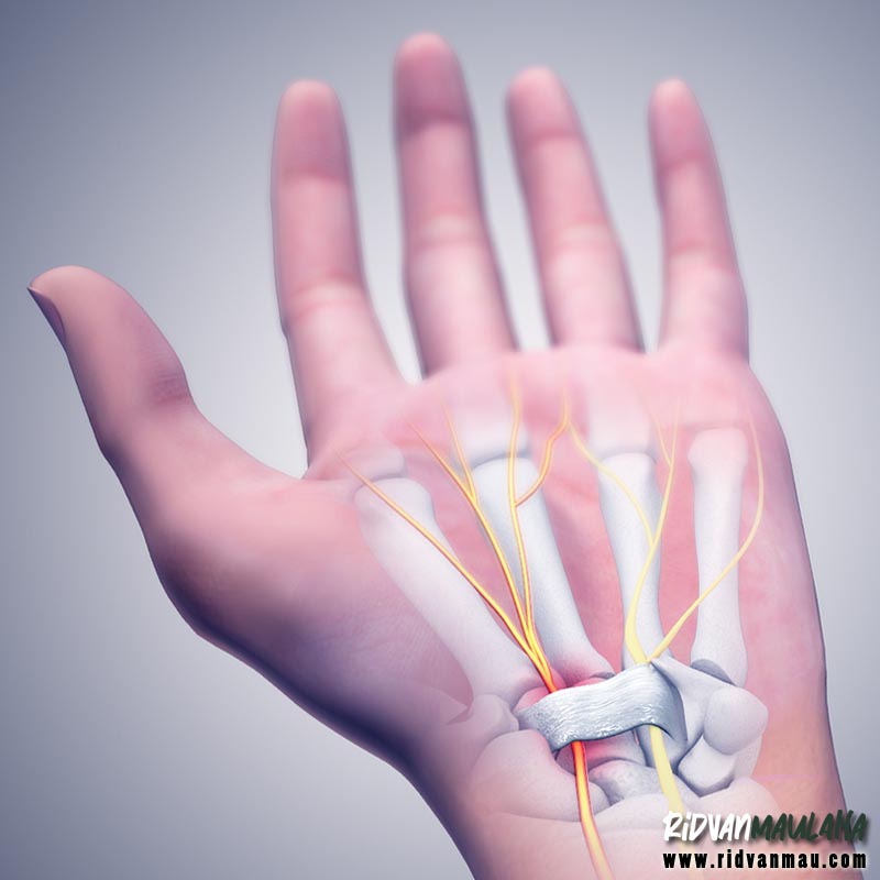 carpal tunnel syndrome adalah